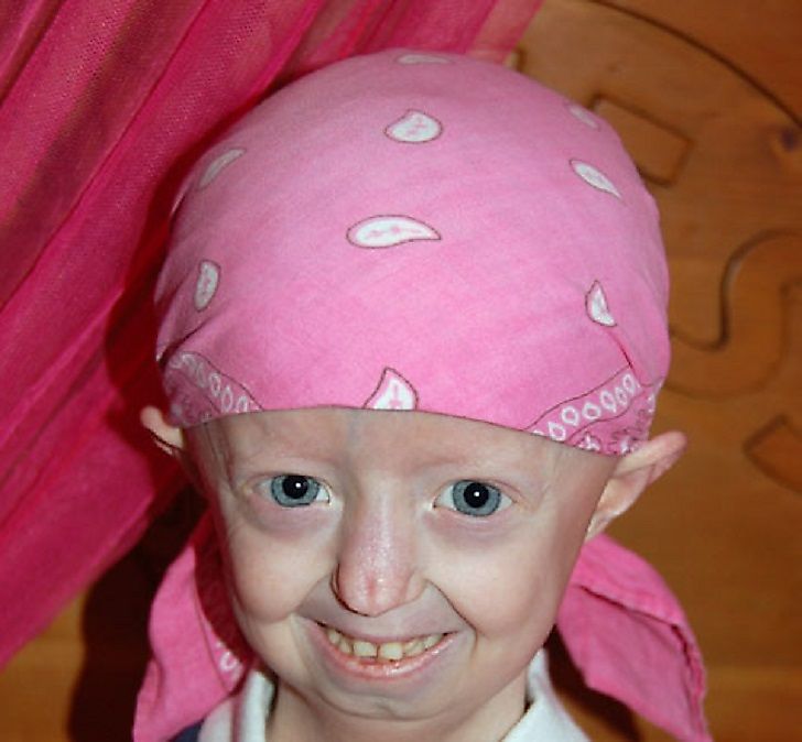 articles about progeria disease articles about progeria disease