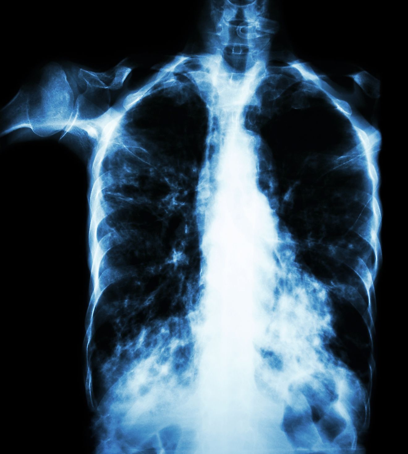 An X-ray of lungs infected with tuberculosis.