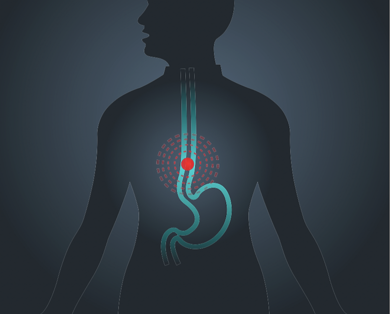 Esophageal Cancer illustration. Image credit: iLoveCoffeeDesign/Shutterstock.com