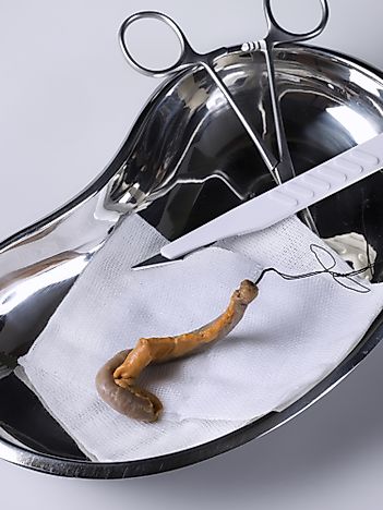 Appendicitis Facts: Diseases of the World