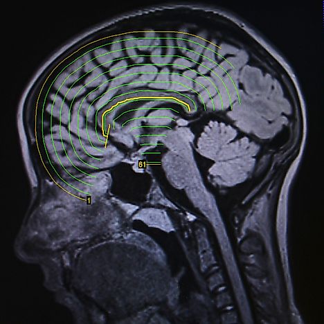 Epilepsy Facts: Diseases of the World