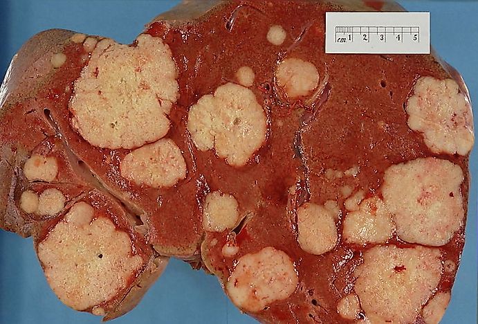 Countries With The Highest Incidence Of Liver Cancer In The World