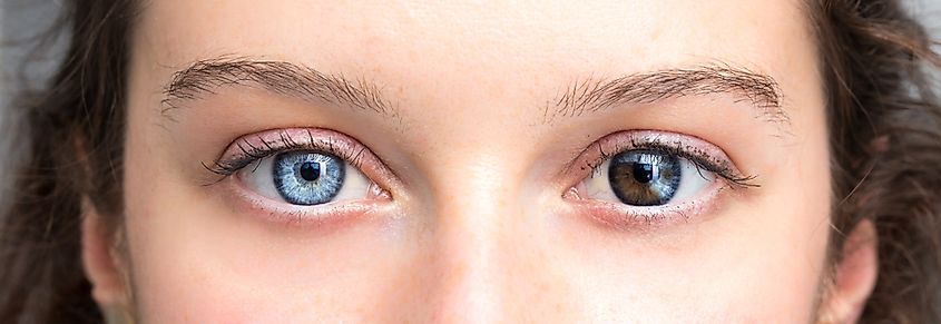Human heterochromia on eyes of girl, blue one and brown one.