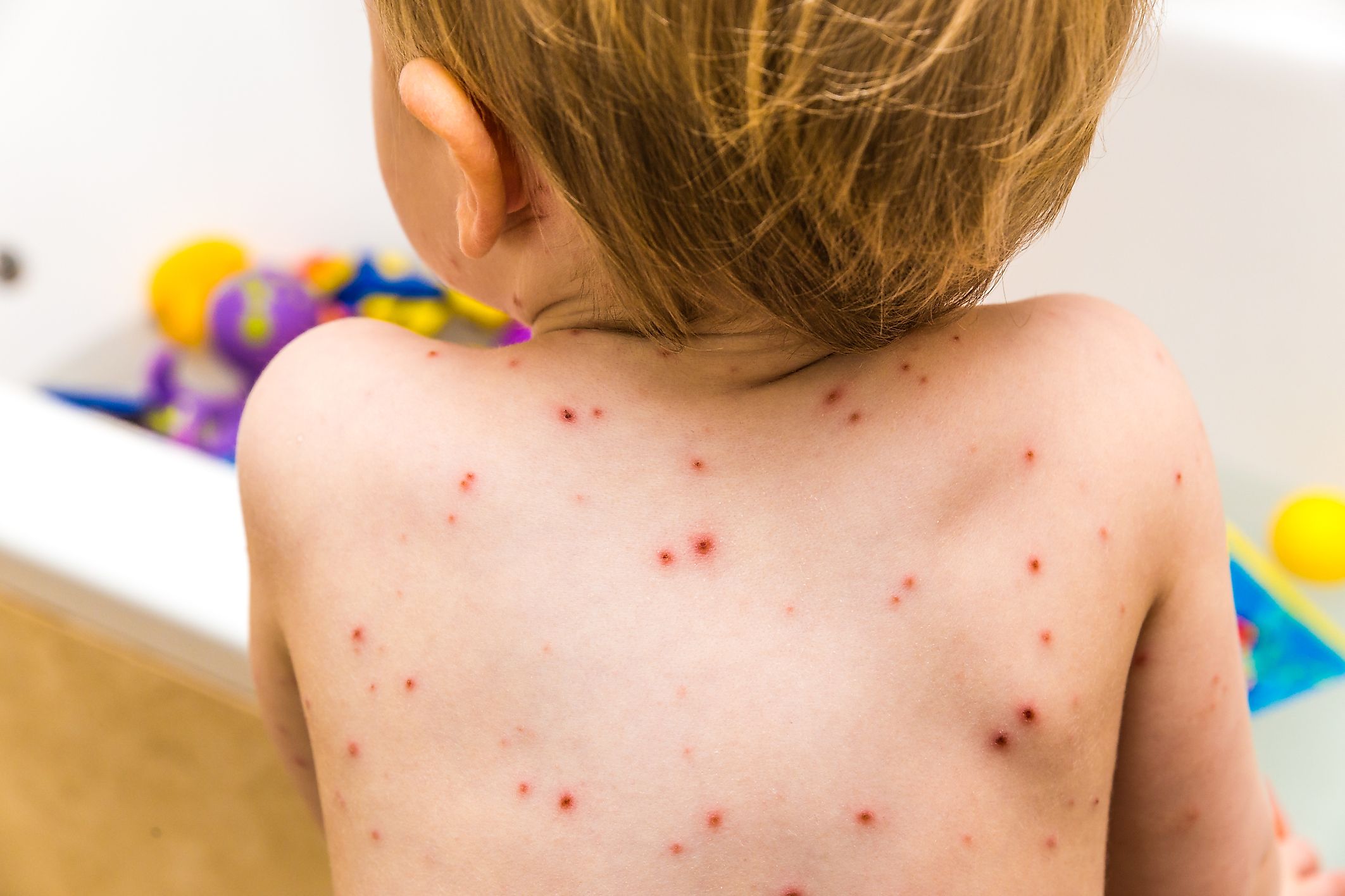 What part of the body does chickenpox affect?