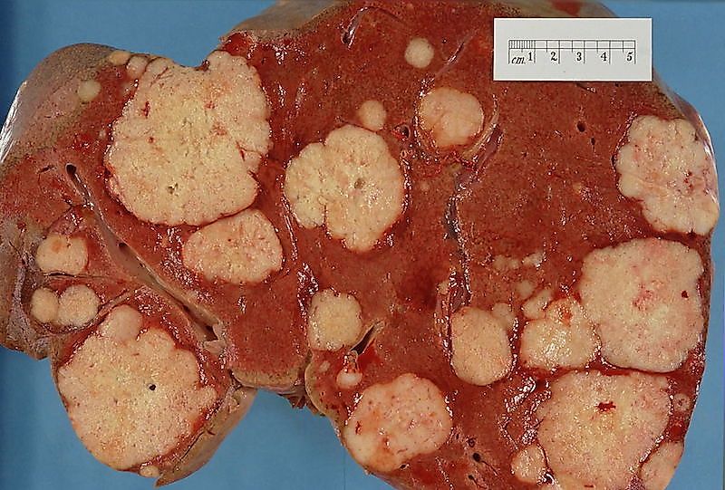 countries with the highest incidence of liver cancer in the world