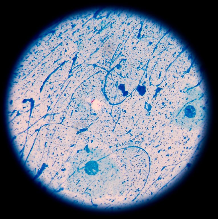 TB Infection Rates