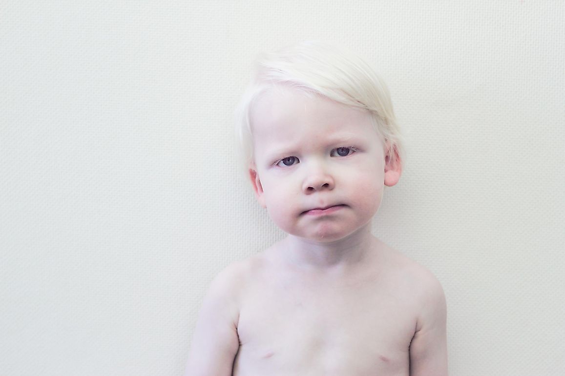 What Is Albinism?