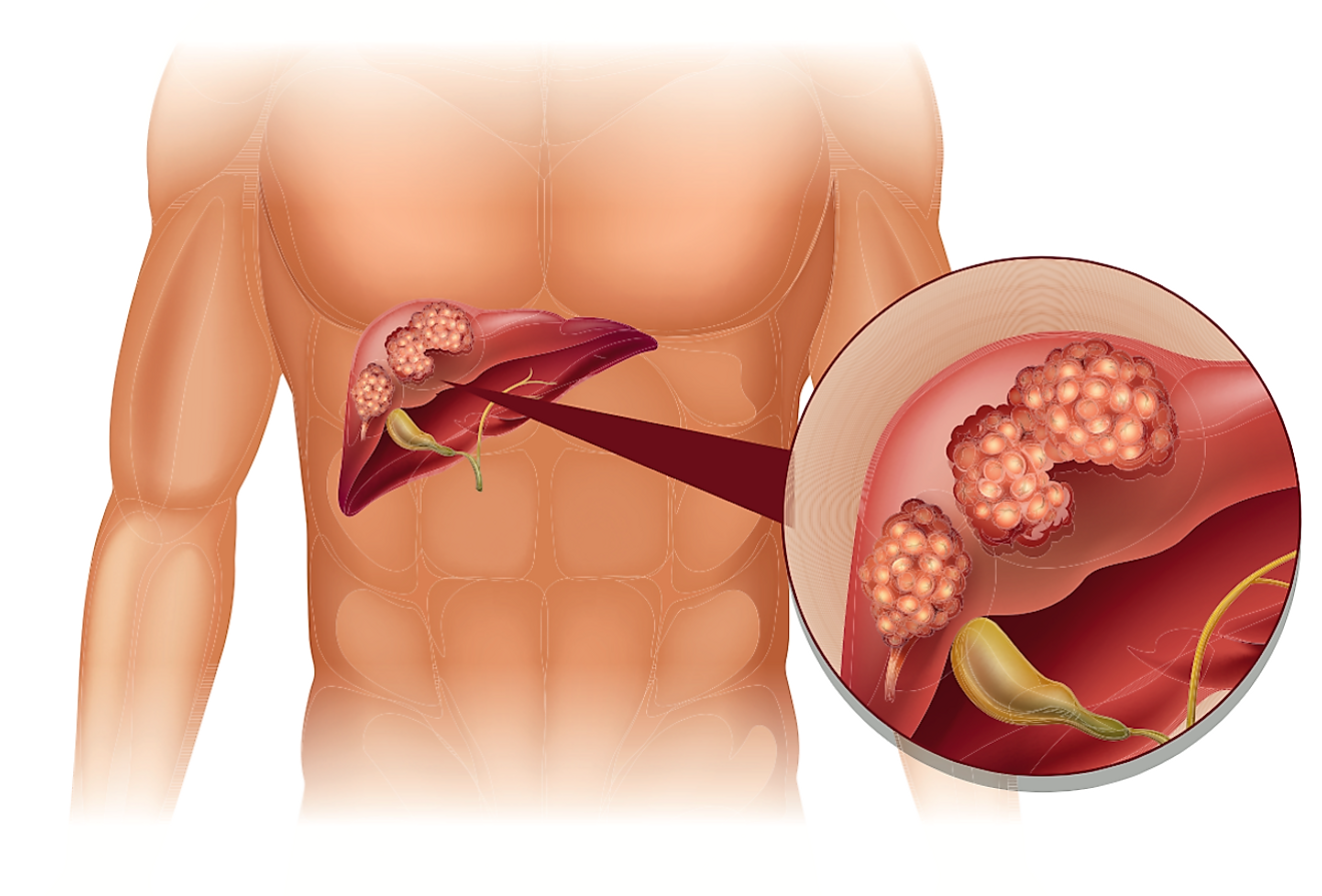 Câncer de fígado na ilustração humana.  Crédito da imagem: BlueRingMedia / Shutterstock.com