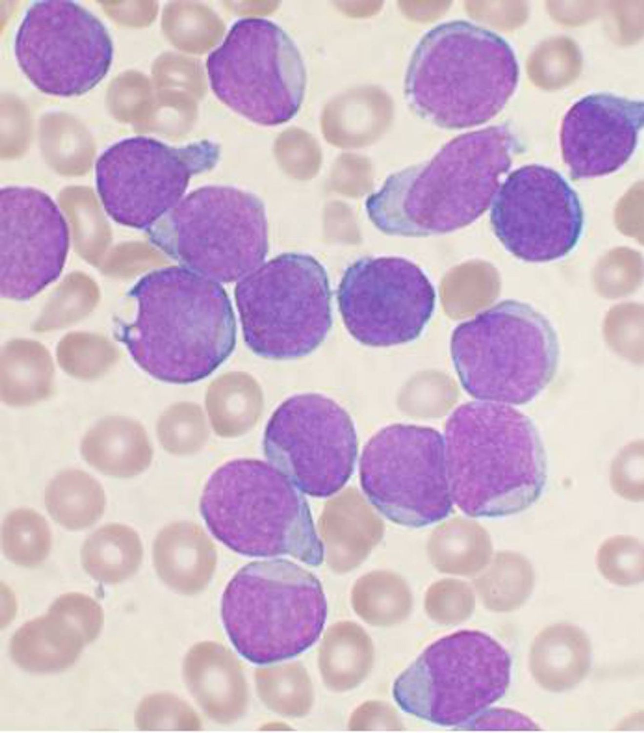 A Wright's stained bone marrow aspirate smear of patient with precursor B-cell acute lymphoblastic leukemia. Image credit: VashiDonsk
