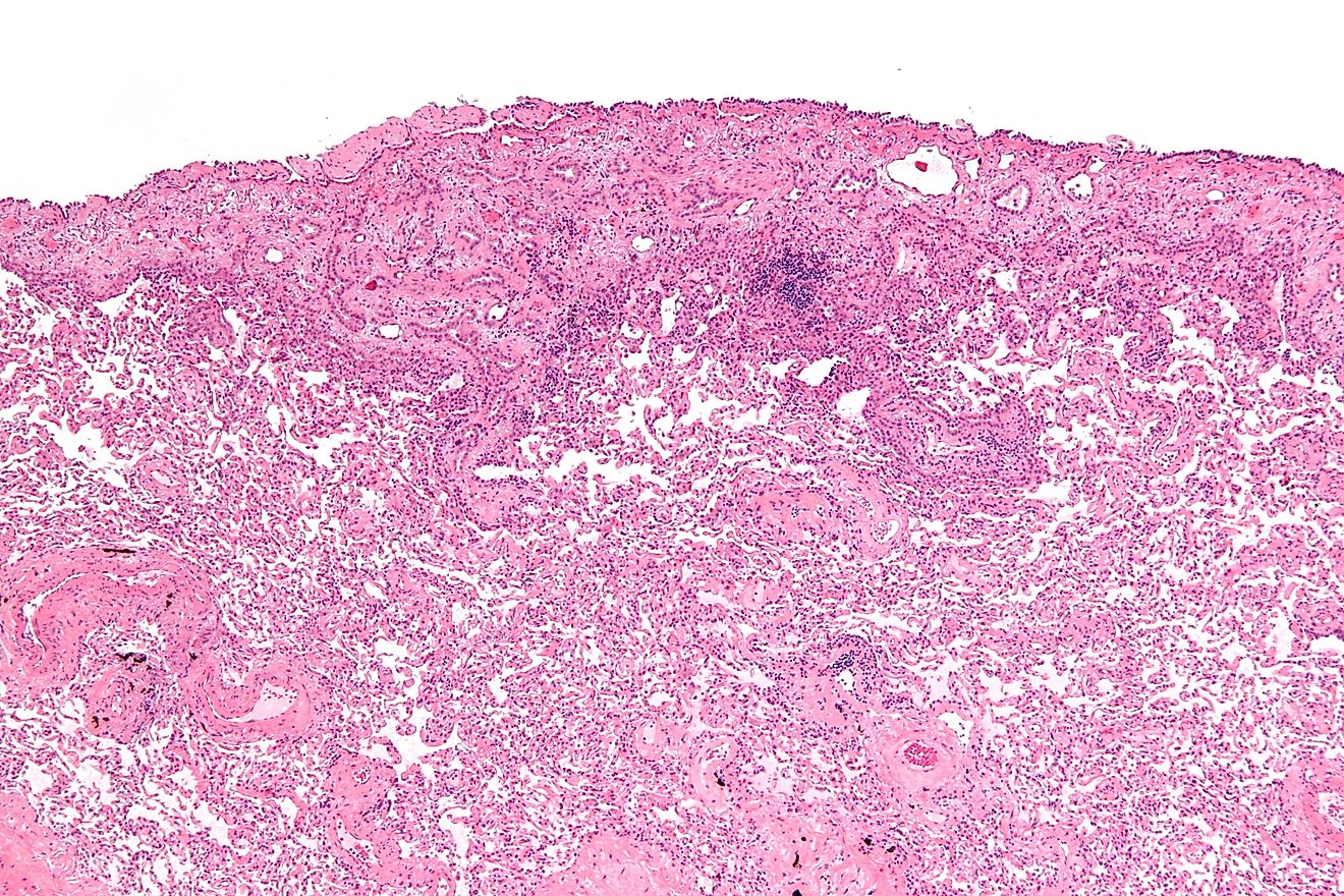 Malignant epithelioid mesothelioma. Nephron/Wikimedia.org