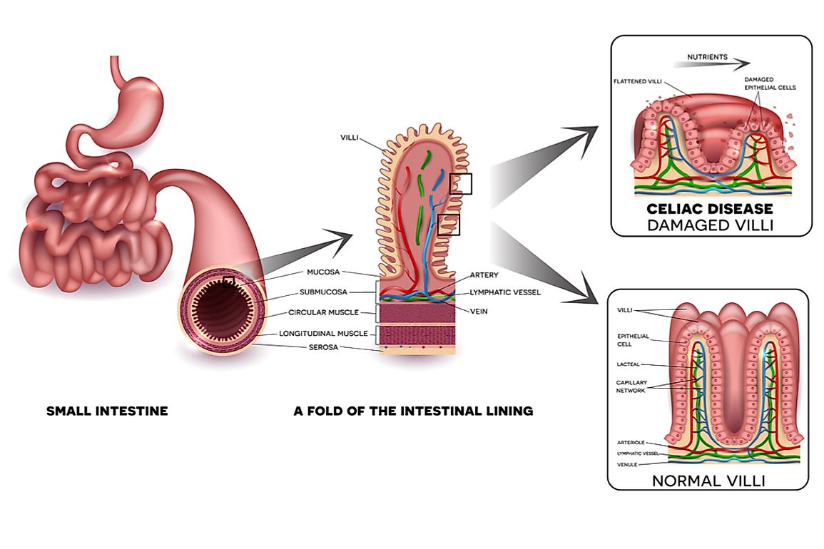 The damage to the small intestine caused my celiac disease results in the malabsorption of nutrients. 