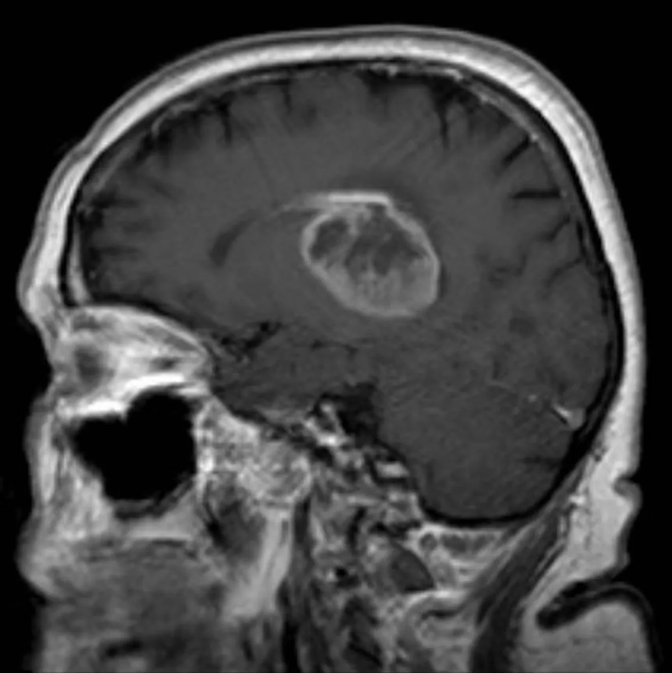 Glioblastoma multiforme. Image credit: Hellerhoff/Wikimedia.org