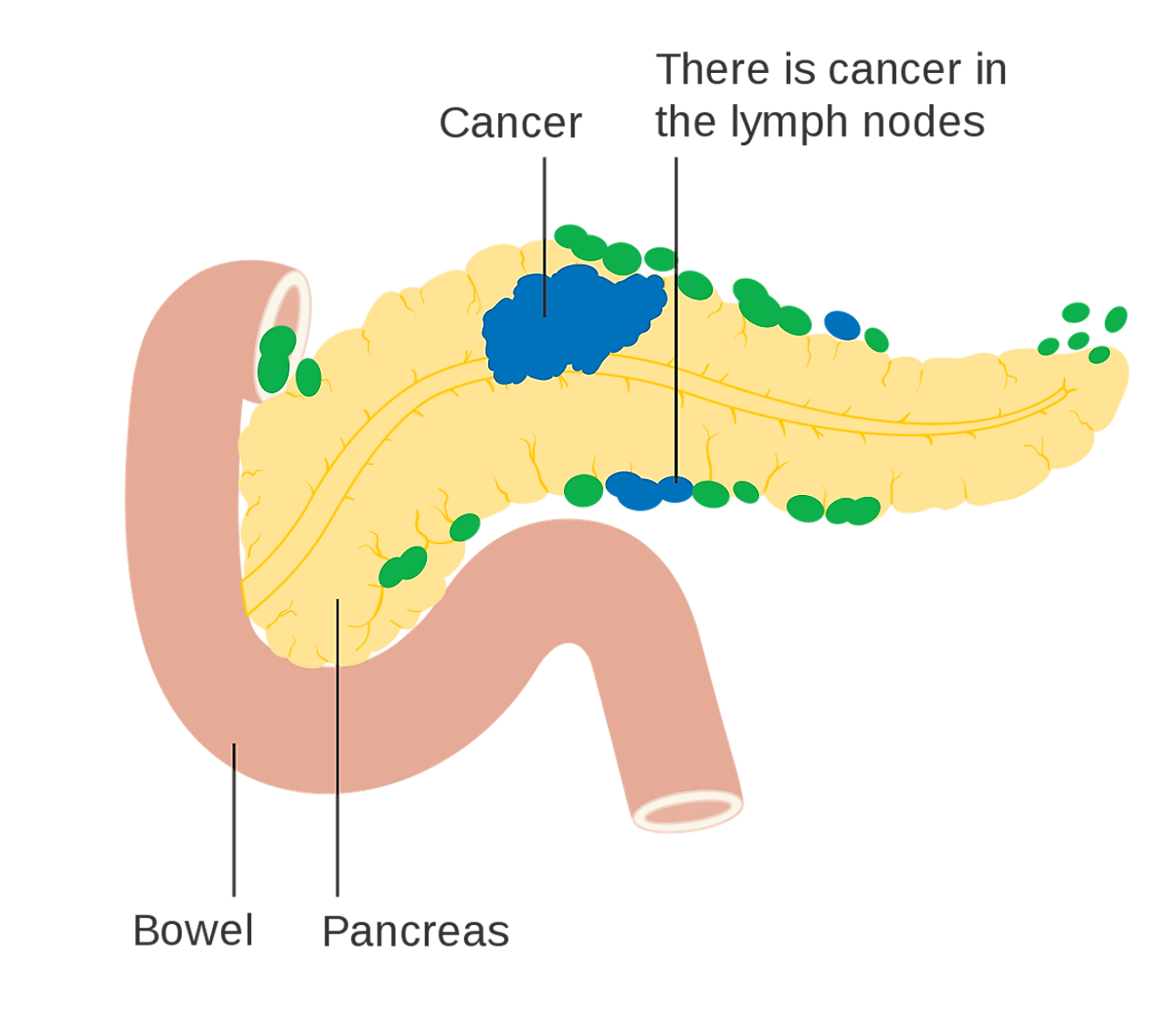 Diagram showing pancreatic cancer in the lymph nodes. Image credit: Cancer Research UK/Wikimedia.org
