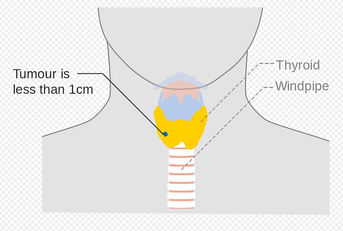 Diagram showing stage thyroid cancer at the earliest stage. Image credit: Cancer Research UK