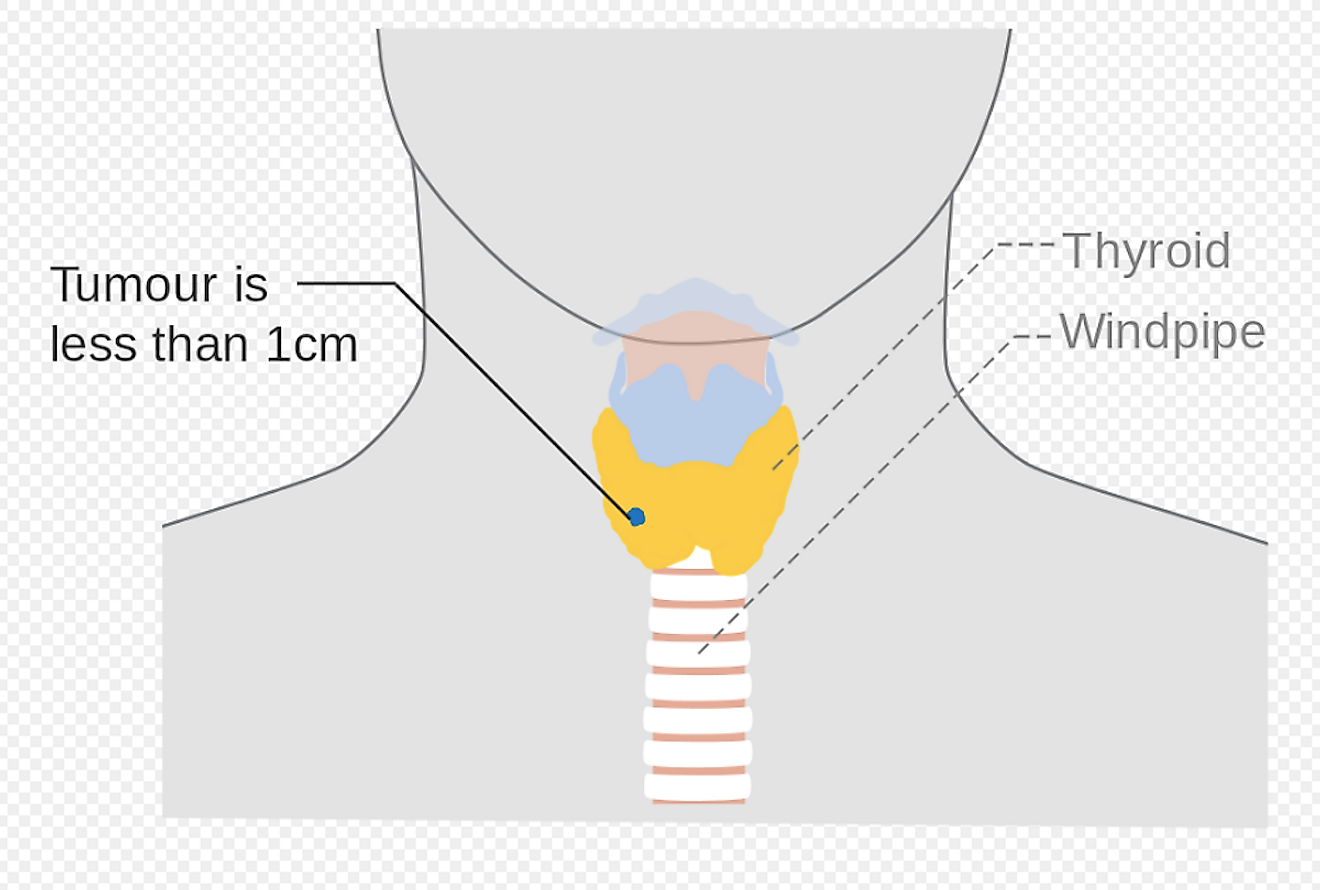 Diagram showing stage thyroid cancer at the earliest stage. Image credit: Cancer Research UK