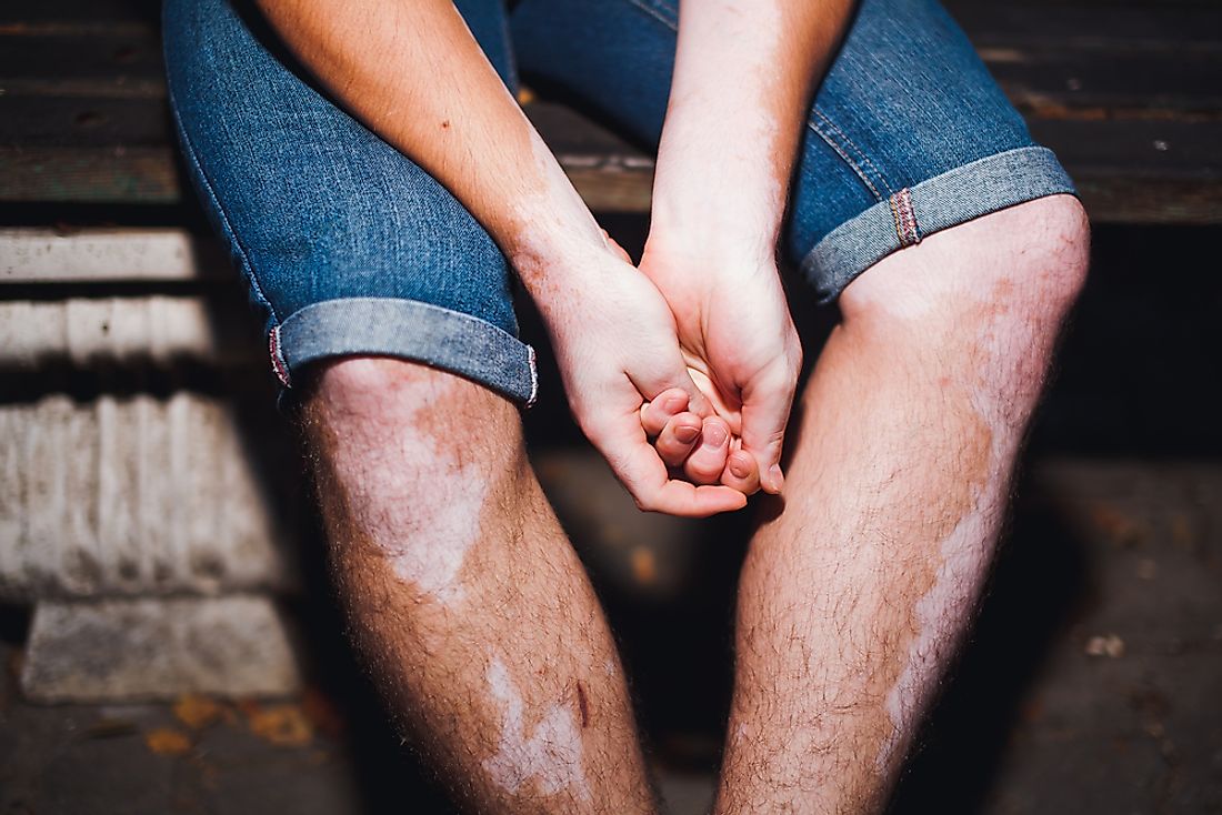 Vitiligo is a chronic autoimmune disease wherein skin patches lose pigmentation. 