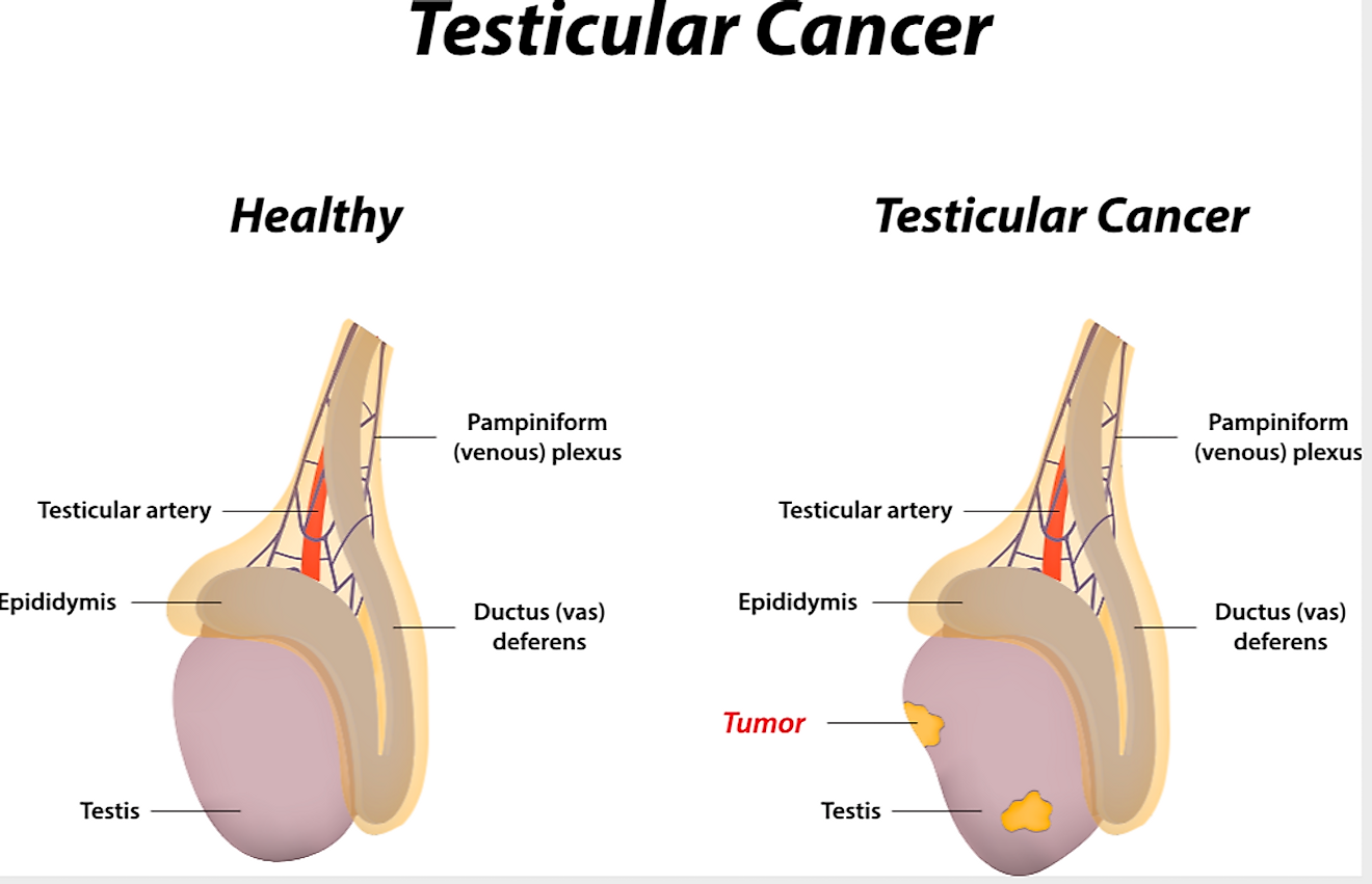 Testicular cancer. Image credit: Joshya/Shutterstock.com