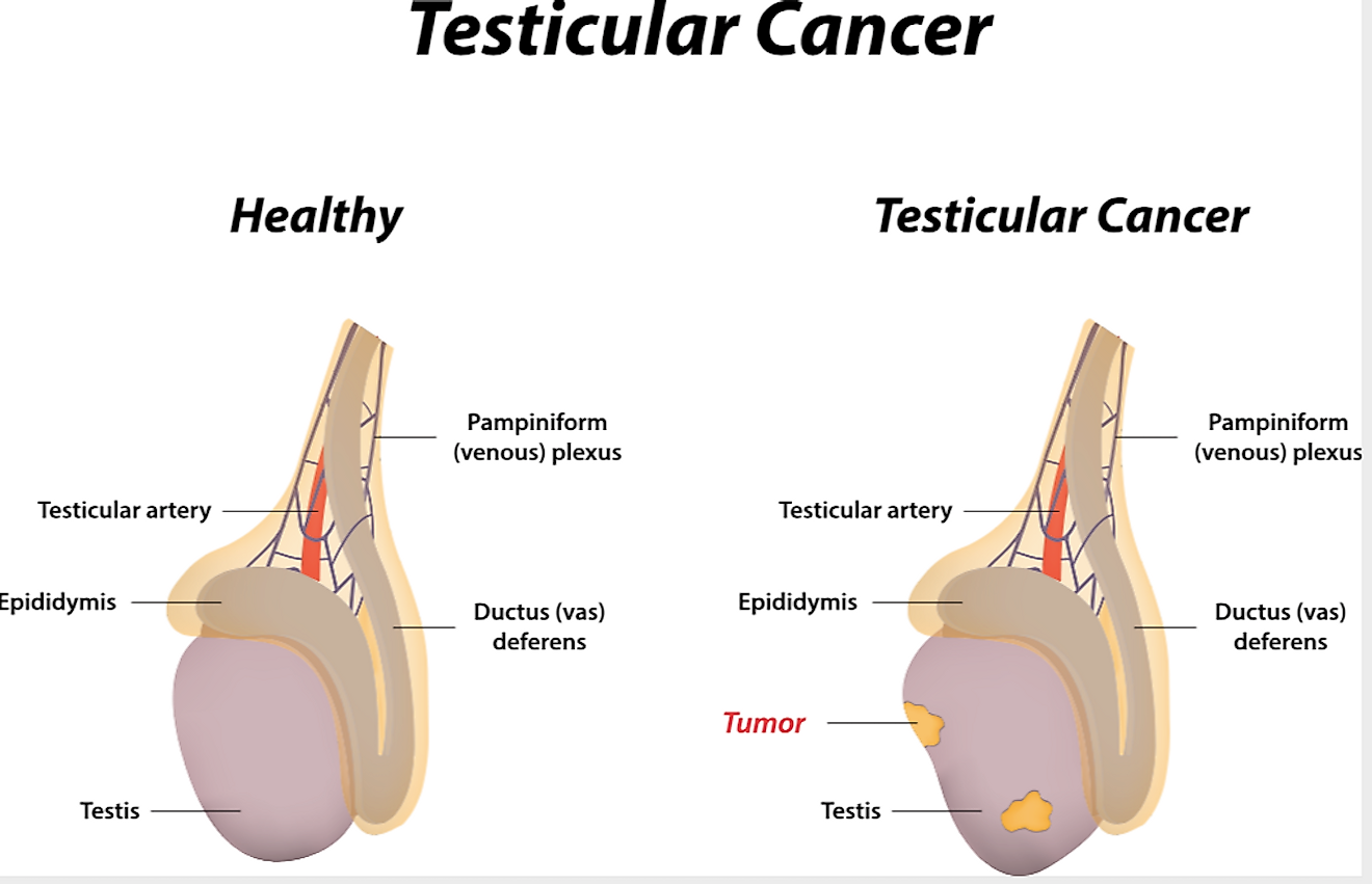 Câncer de testículo.  Crédito da imagem: Joshya / Shutterstock.com