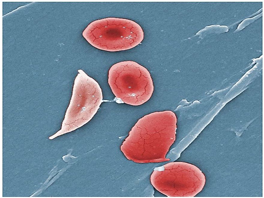A colored scanning electron microscope image of normal blood cells next to a sickle-blood cell.