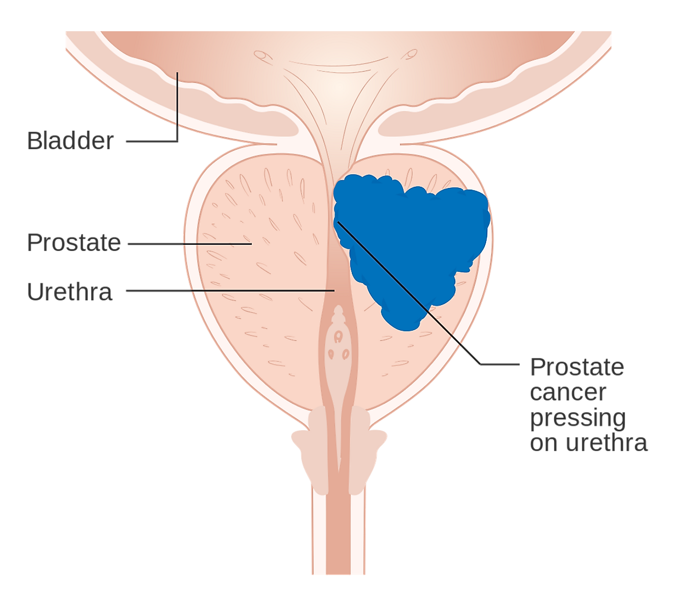 A diagram of prostate cancer pressing on the urethra, which can cause symptoms. Image credit: Cancer Research UK/Wikimedia.org