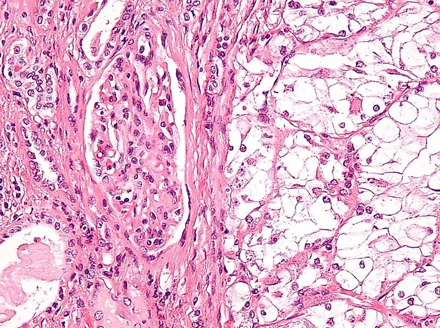 High magnification micrograph of a clear cell renal cell carcinoma.