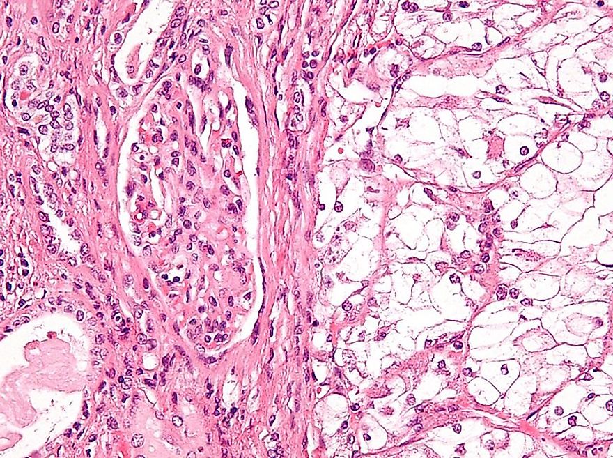 High magnification micrograph of a clear cell renal cell carcinoma.