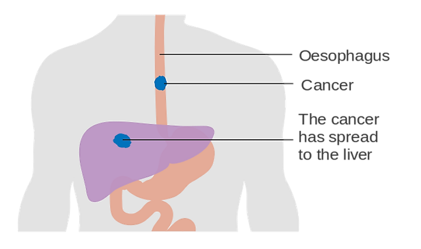 A diagram representing the metastasis of esophageal cancer.