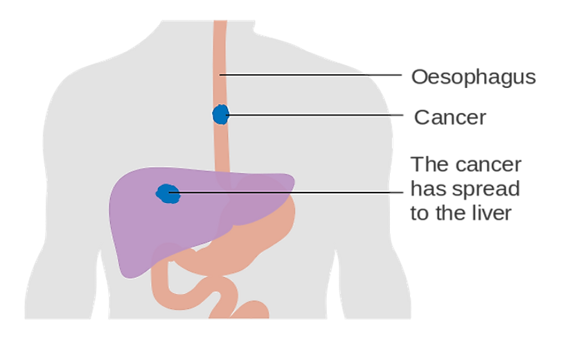 Countries With The Highest Rates Of Esophageal Cancer Worldatlas