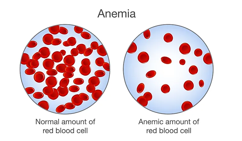 Children in countries across sub-Saharan Africa suffer from high rates of anemia due to poverty and malnutrition.