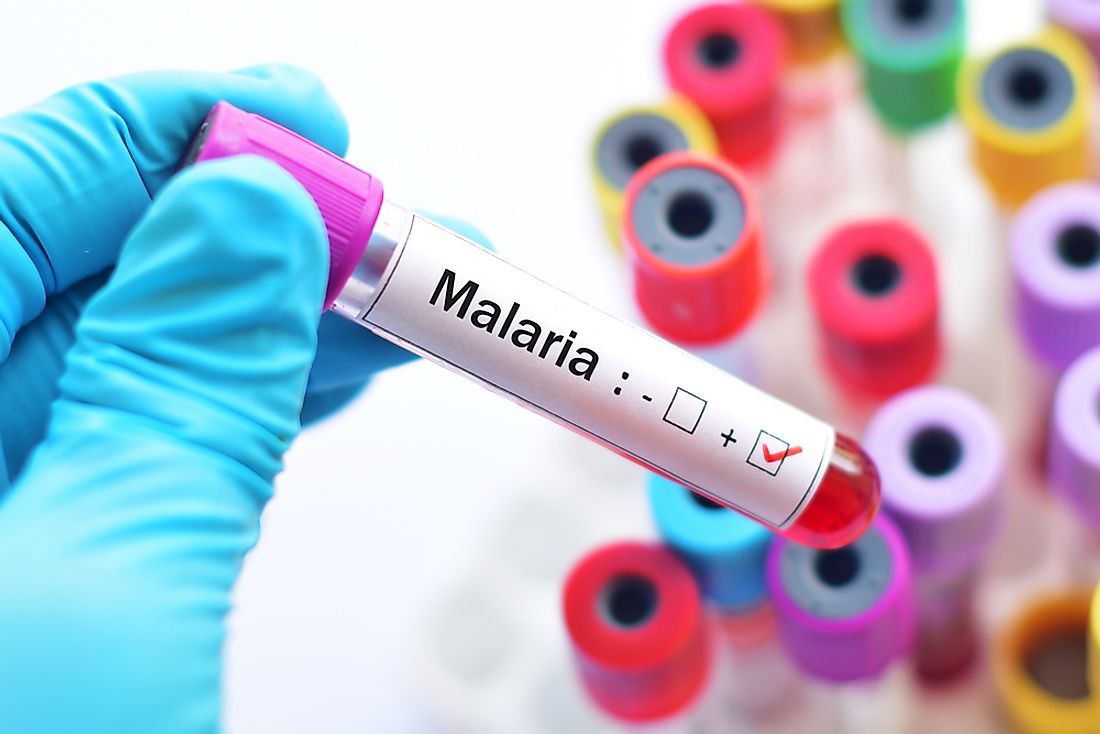 Blood sample with malaria parasite positive.