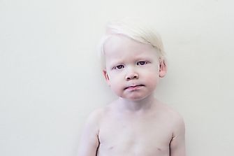 What Is Albinism?