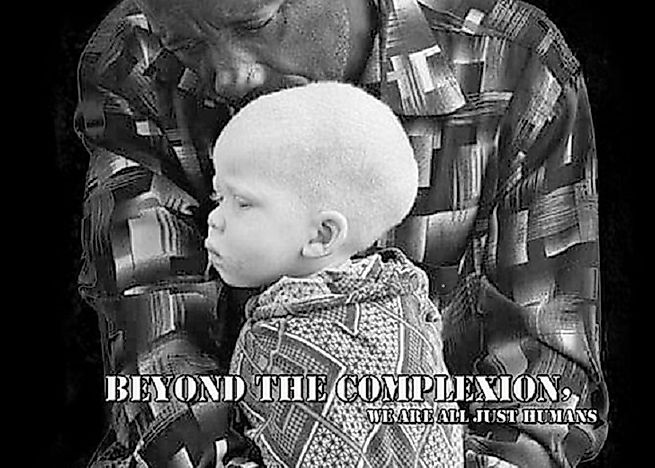 Albinos of Southern Africa: Humans Being Hunted, Dismembered, And Sold