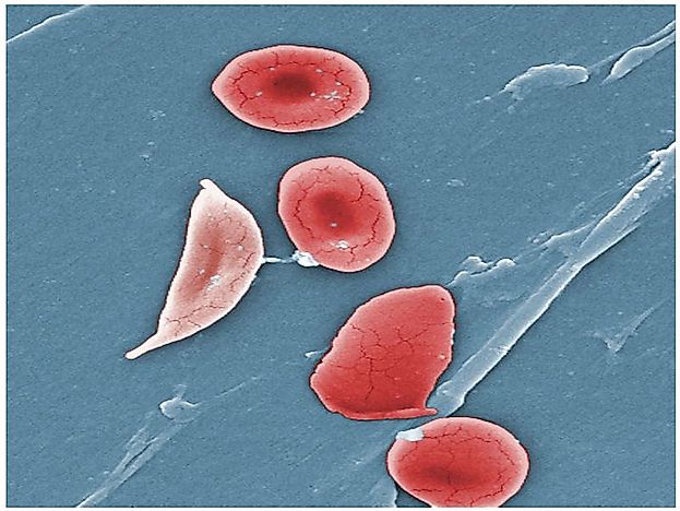 Highest Numbers Of Sickle Cell Births By Country