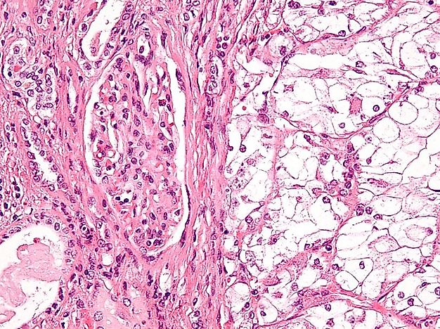 Countries With The Highest Incidences Of Kidney Cancer In The World
