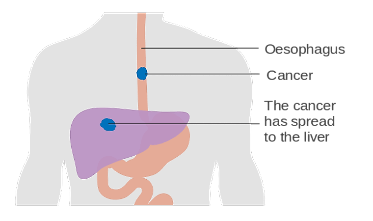Countries With The Highest Rates Of Esophageal Cancer
