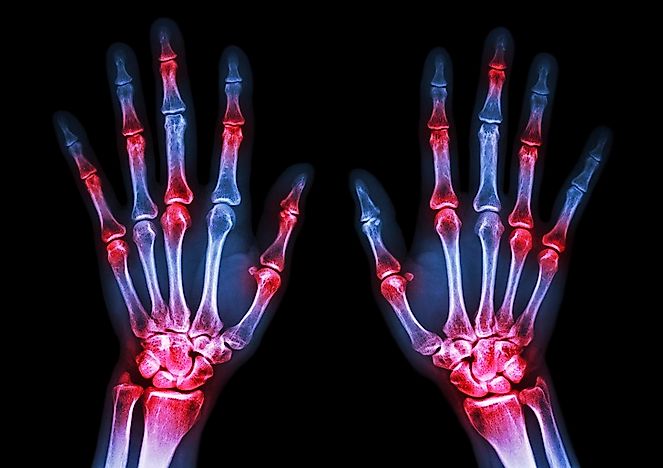 U.S. States With The Highest Rates Of Adult Arthritis