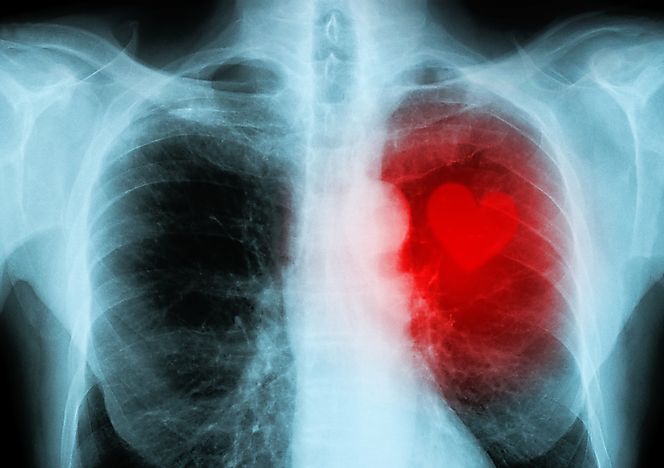 Top Ten Leading Causes Of Death In The World