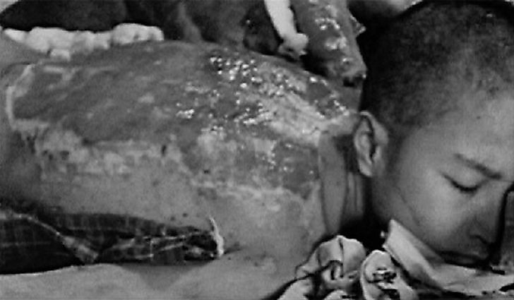 The Hibakusha - Survivors Of The Hiroshima And Nagasaki Atomic Bombs