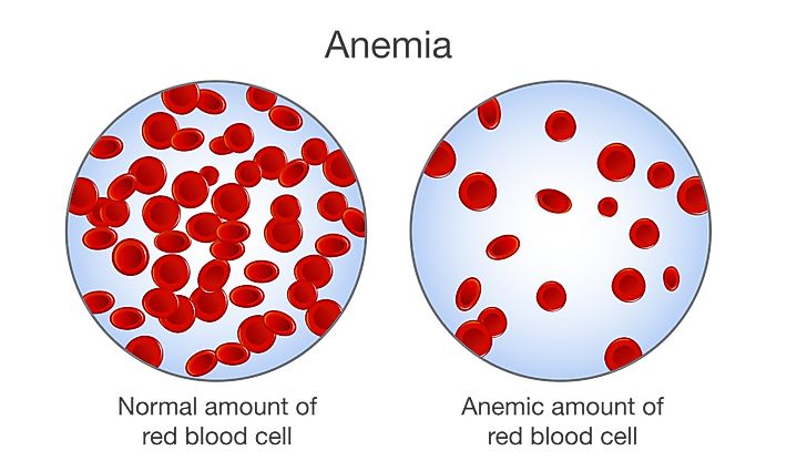 Anemia in Children - Prevalence Around the World