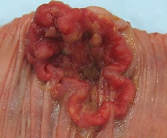 Can Cancer Be Contagious?