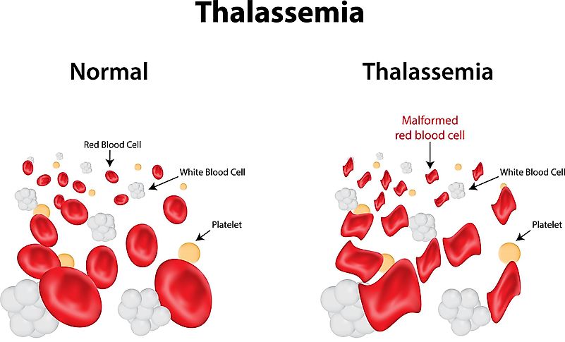 This is another disorder that is caused by defective production of hemoglobin. This is another disorder that is caused by defective production of hemoglobin.