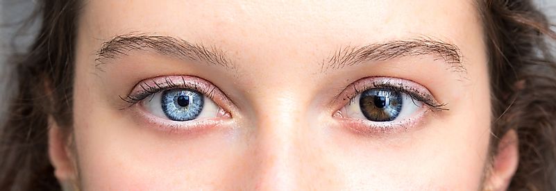Kız, mavi ve kahverengi bir insan gözünde insan heterokromisi.