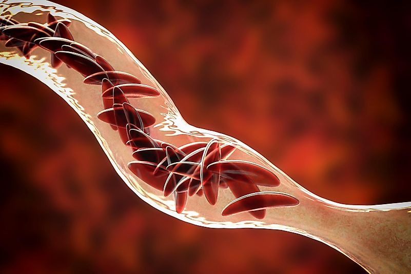 Clumps of sickle cell block the blood vessel. Clumps of sickle cell block the blood vessel.