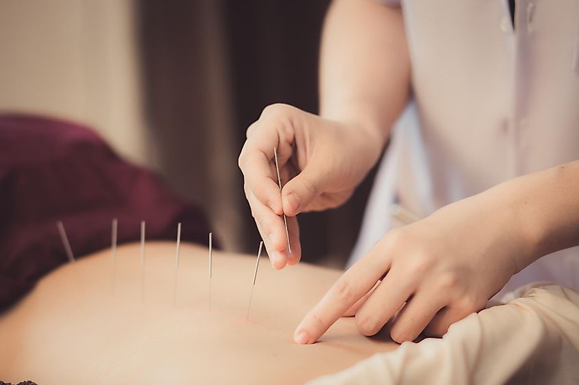 Adult physiotherapist is doing acupuncture on the back of a patient.