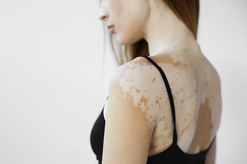 Loss of melanin - vitiligo.