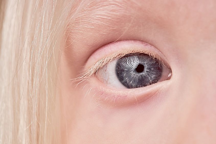 Violet Eyes - Albinism 