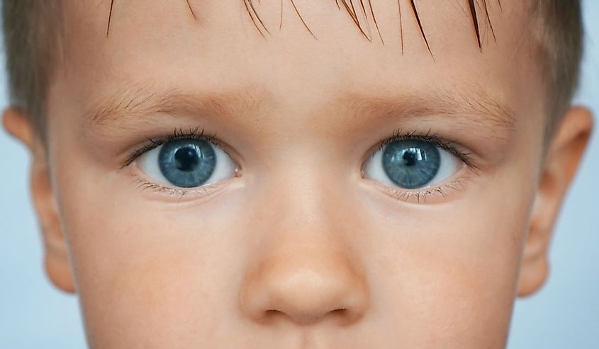 A child with blue eyes with symptoms of Anisocoria, pupils of different size.