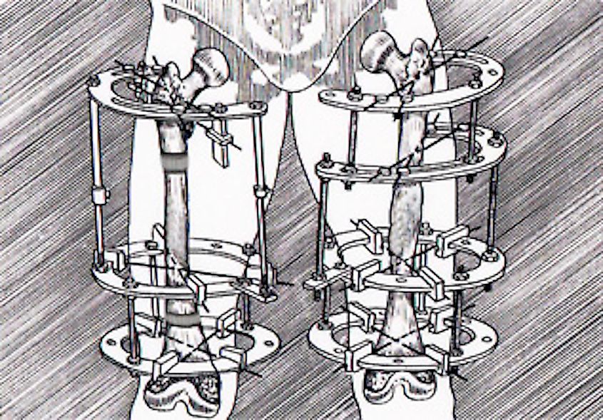 An Ilizarov apparatus fitted to a patient's leg.