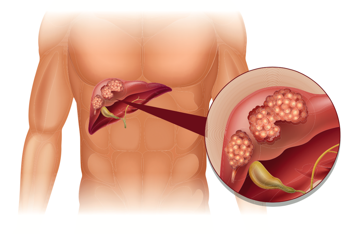 Liver cancer in human illustration. Image credit: BlueRingMedia/Shutterstock.com