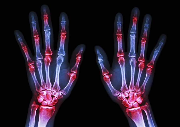 Inflammation of the hand joints in an arthritis sufferer.